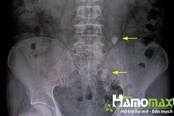 Phim chụp X Quang của bệnh nhân bị sỏi thận