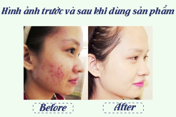 Trước và sau khi dùng sản phẩm 1 tuần.