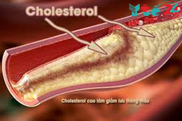 Điều trị cholesterol cao