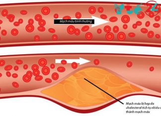 Cholesterol trong máu cao