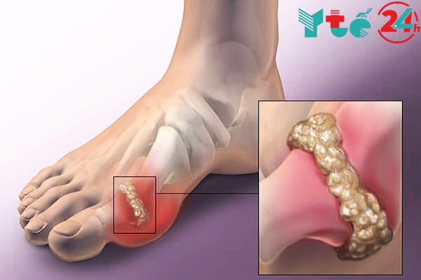 Tìm hiểu chung về bệnh gout và phương pháp trị bệnh gout