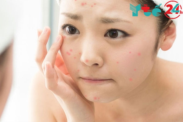 Lotion có khả năng trị mụn